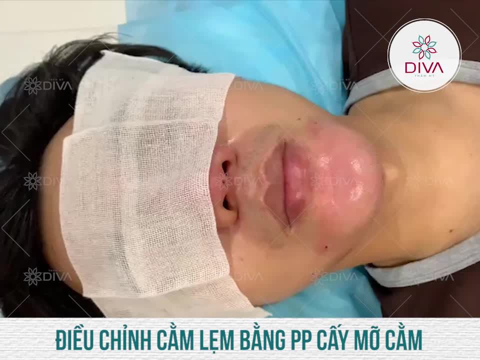 TẠM BIỆT CẰM LẸM, THIẾU CÂN ĐỐI SAU CẤY MỠ COLEMAN