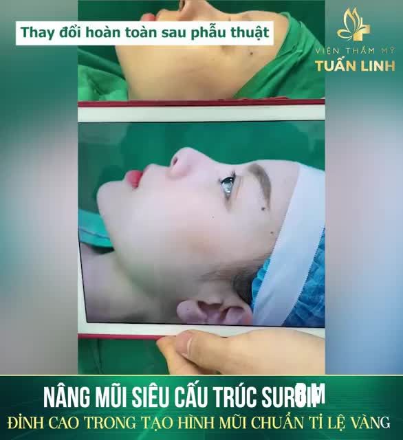Mũi đã được 6 năm nhưng bị nghiêng, đầu mũi ngắn hếch nhiều sống mũi to thô bị bao sơ...