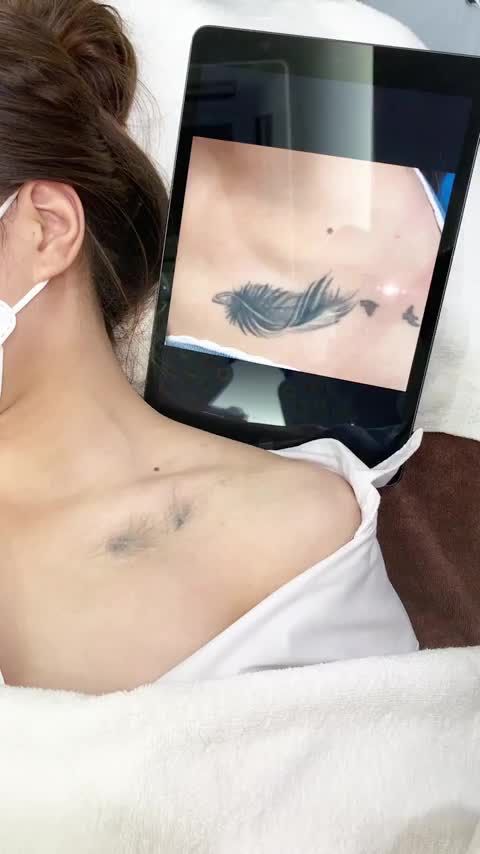 Cận cảnh kết quả xóa xăm 5 buổi Xóa xăm tại Kangnam
