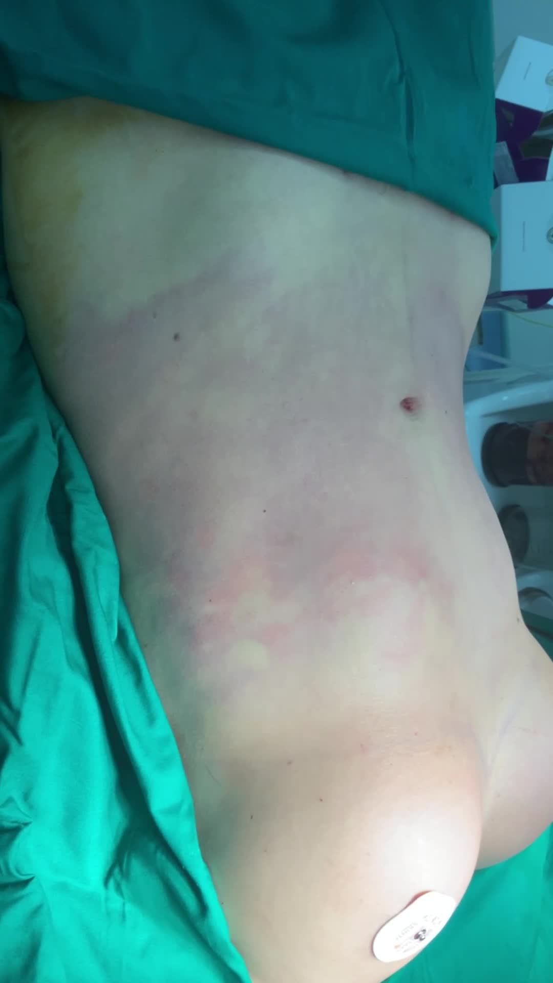 Combo hút kiệt mỡ bụng, nâng ngực nano chip 300c, cấy mỡ ngực & thu nhỏ đầu t.i..... với Dr Vương