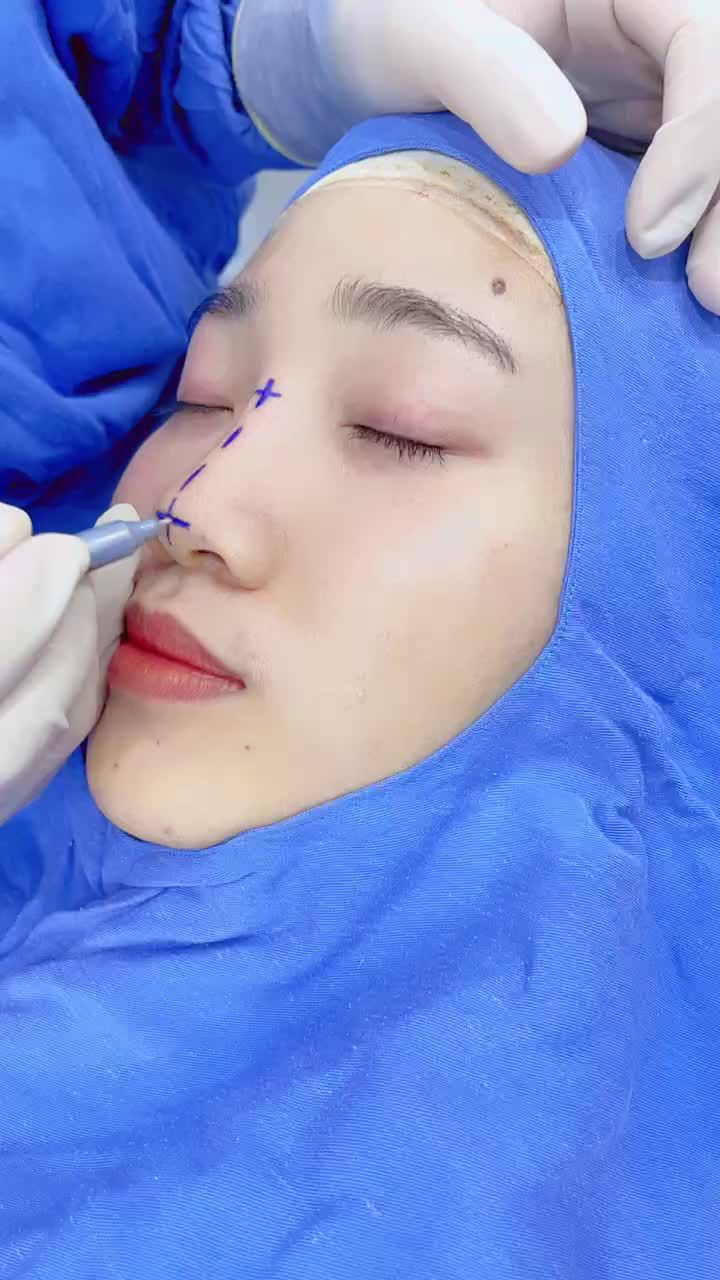QUAY XE CHỌN LẠI Nâng mũi 6D nhà Kangnam sau khi nâng mũi bằng chỉ ở nơi khác