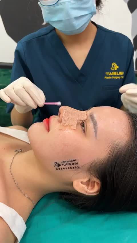 CẬN CẢNH MŨI CẤU TRÚC NUỘT ĐẾN TỪNG CHI TIẾT SAU 10 NGÀY THÁO NẸP