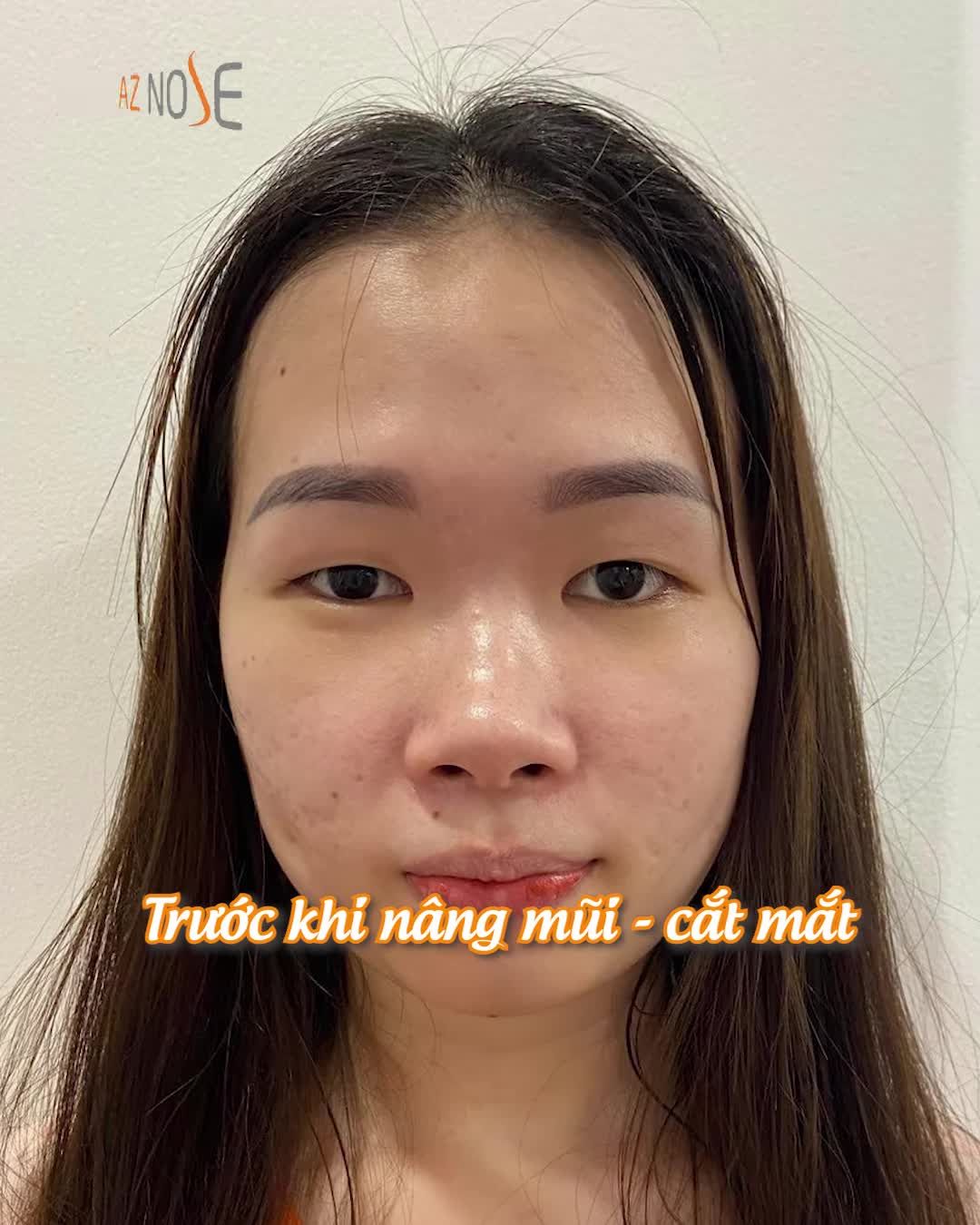 Thay đổi toàn diện với combo nâng mũi - cắt mắt