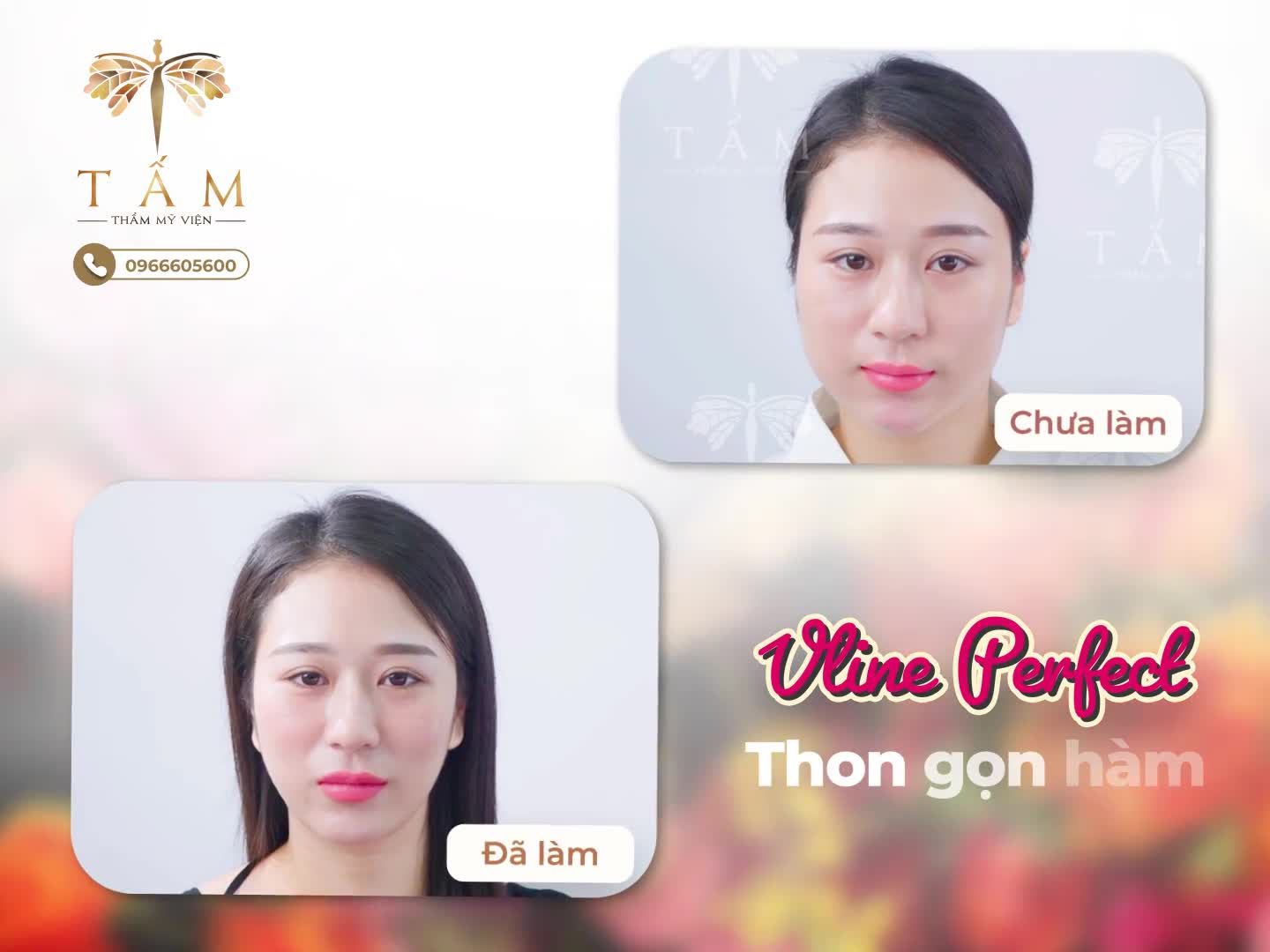 VLINE PERFECT - TỰ HÀO LÀ CÔNG NGHỆ HIỆN ĐẠI LÀM GỌN HÀM KHÔNG XÂM LẤN HÀNG ĐẦU VIỆT NAM