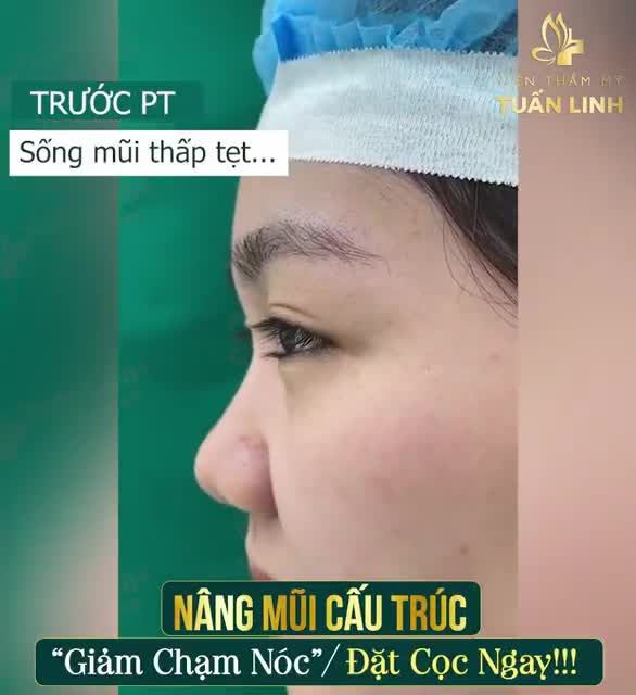 THAY ĐỔI 360 ĐỘ MŨI ĐẸP XUẤT SẮC SAU 90 PHÚT NÂNG MŨI CẤU TRÚC