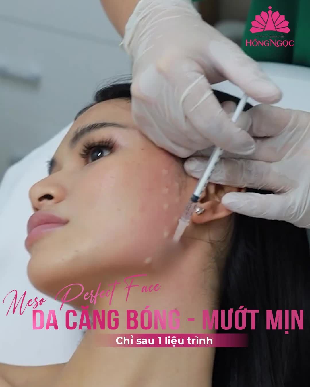 CẢ NĂM CHĂM DA KHÔNG BẰNG 1 LẦN SỬ DỤNG MESO PERFECT FACE