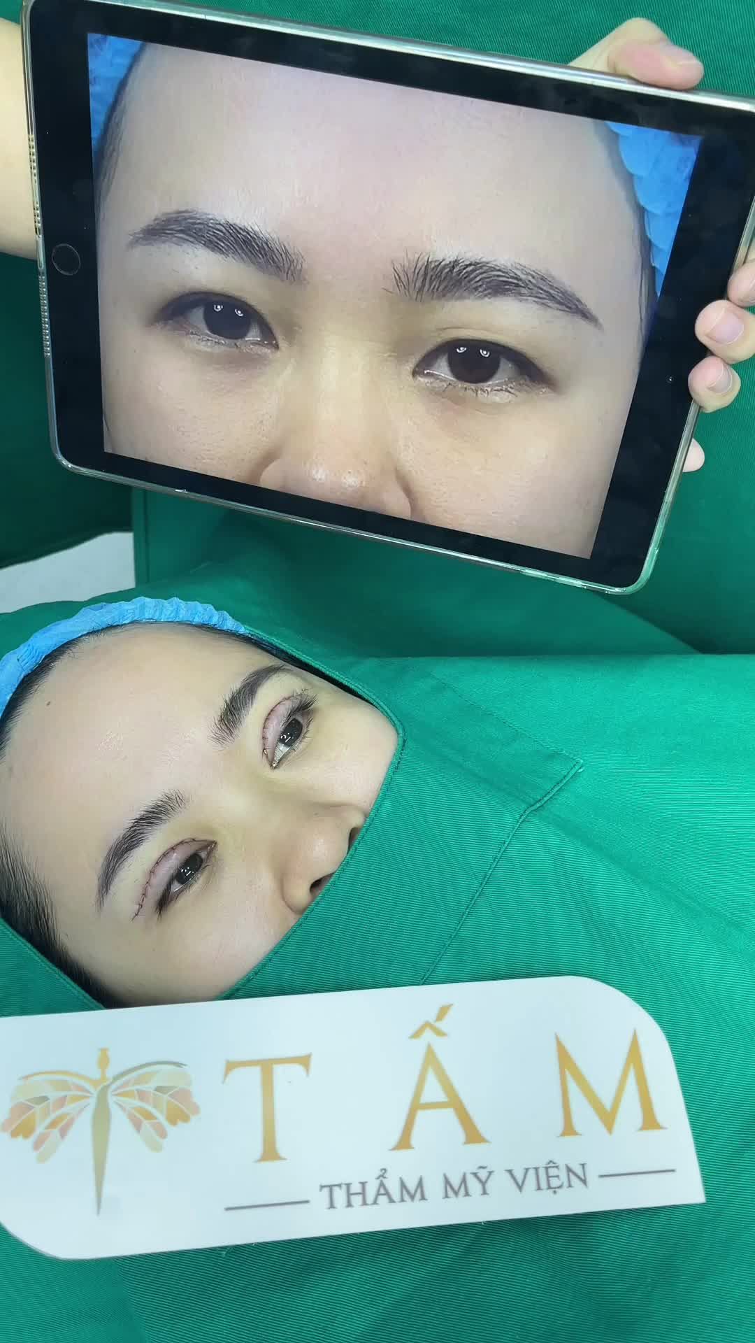 Kết quả không thể ưng ý hơn sau khi thực hiện Perfect Eyes Cắt mí + bóc mỡ tại TMV Tấm. Mọi người cùng theo dõi nhé!