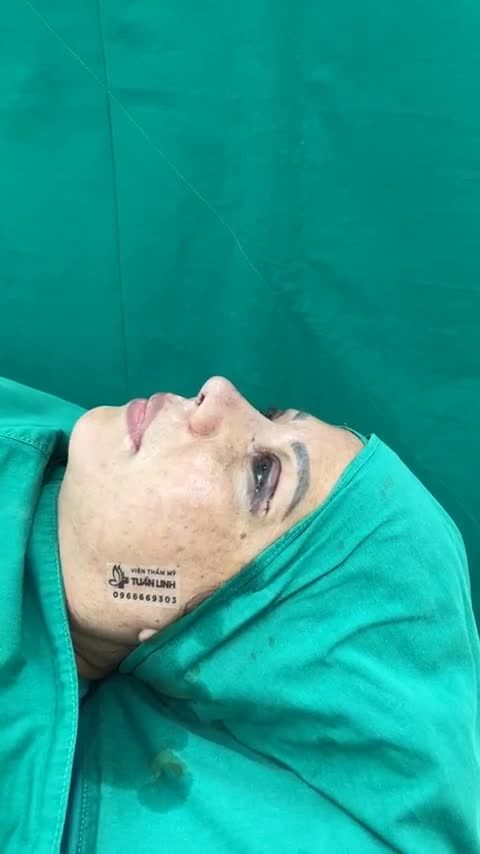 Phương pháp Nâng mũi cấu trúc sửa lại sụn surgiform.