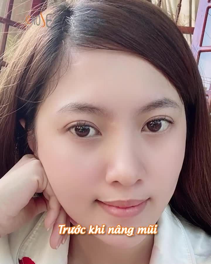 Từ Vũng Tàu đến AZ NOSE nâng mũi và cái kết ngọt ngào