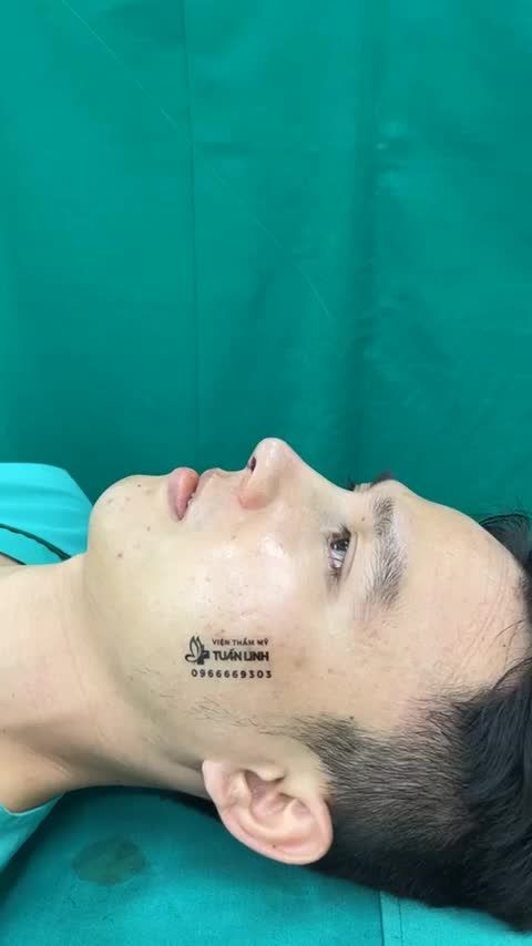 DÁNG MŨI HOTBOY CẢI THIỆN KHUÔN MẶT GÃY CHO CHÀNG TRAI 9X