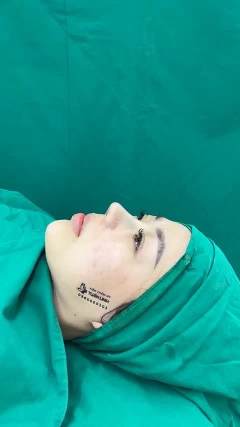 NÂNG MŨI CẤU TRÚC - CHỈNH SỬA CÁNH MŨI ( ĐÃ TỪNG CẮT) BỊ SẸO XẤU VÀ KẾT QUẢ SAU 90 PHÚT THỰC HIỆN