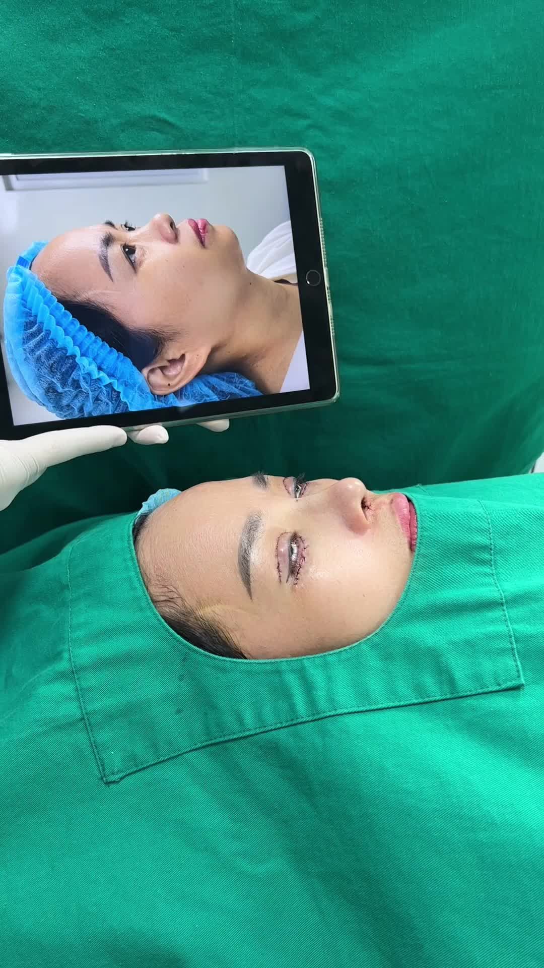 Thành quả sau khi thực hiện Combo Nâng mũi + Cắt mí trên và cắt mí dưới tại Tấm.