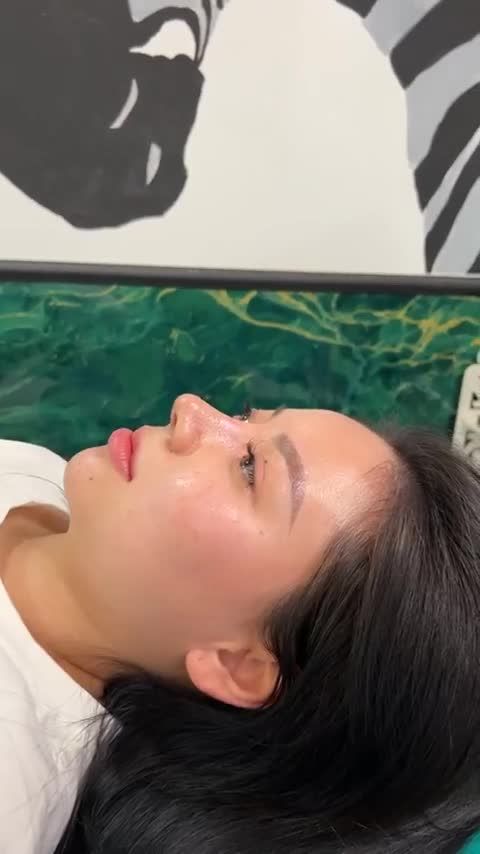 KẾT QUẢ SAU 10 NGÀY CỦA CÔ GÁI TỪ #MỸ VỀ VIỆT NAM NÂNG MŨI TẠI TUẤN LINH