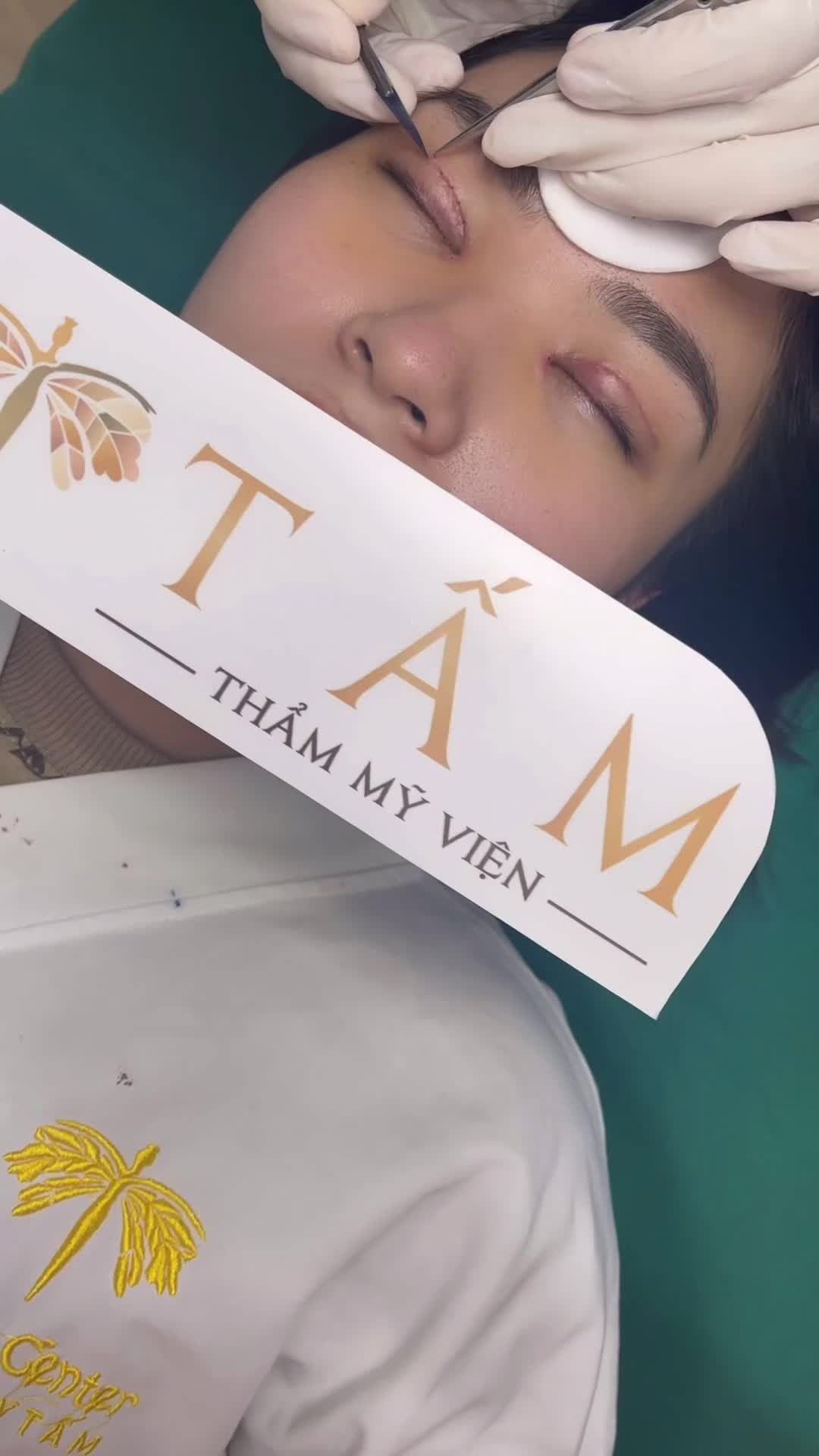 Khách hàng tới tái khám và thực hiện cắt chỉ sau 6 ngày tại TMV Tấm. Mắt dần ổn định và vào form.