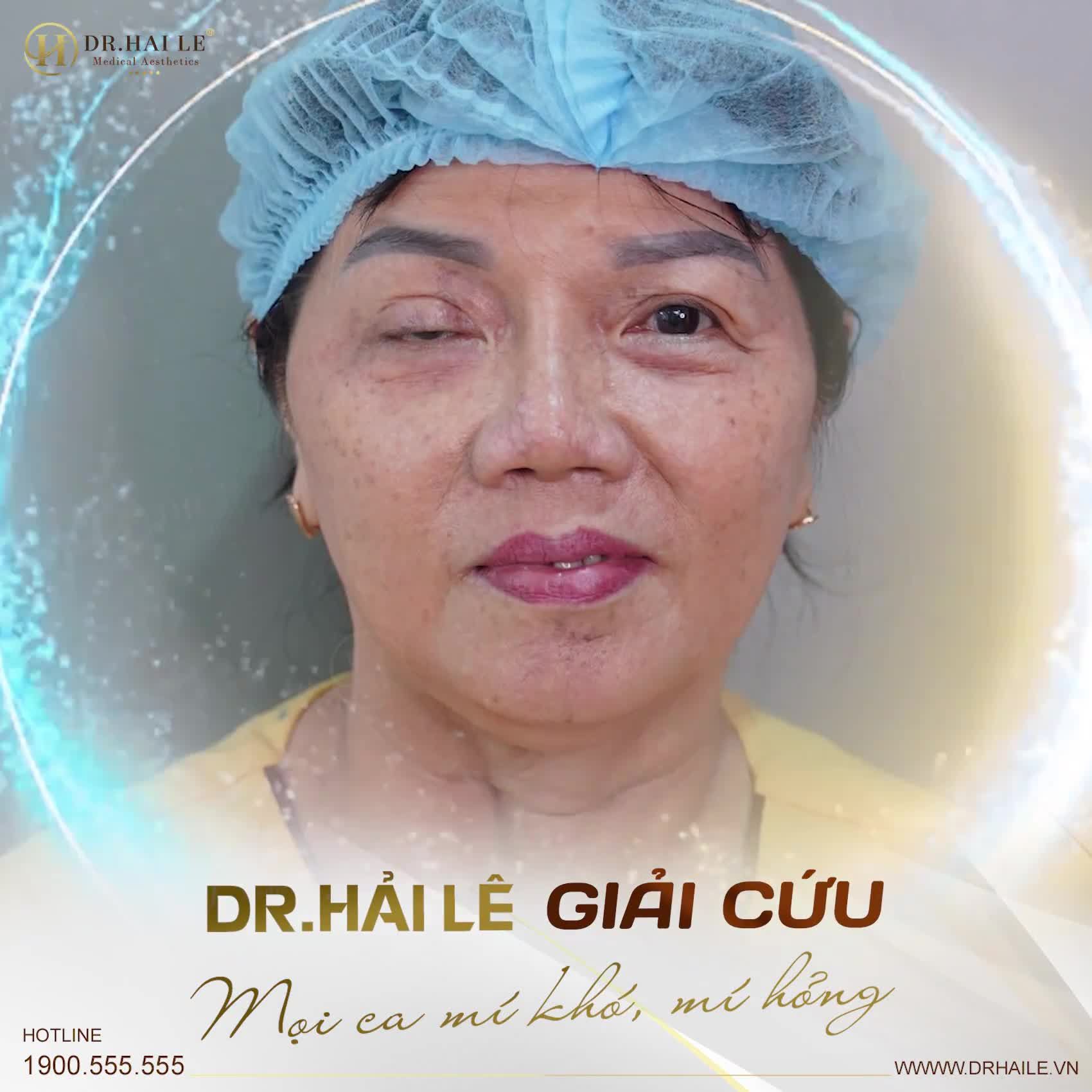 Dr.Hải Lê "GIẢI CỨU" mọi ca mí hỏng từ nhẹ tới nặng