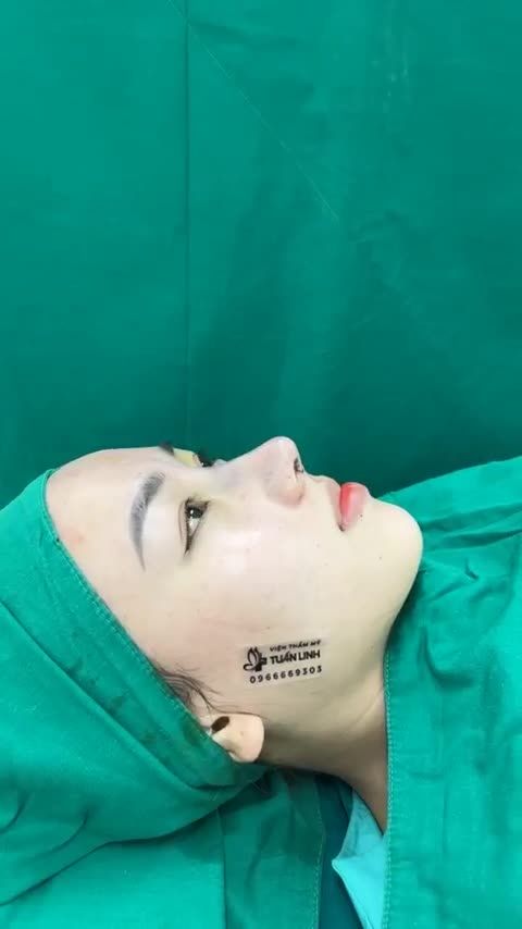 NÂNG MŨI CẤU TRÚC KẾT HỢP BỌC MEGADERM