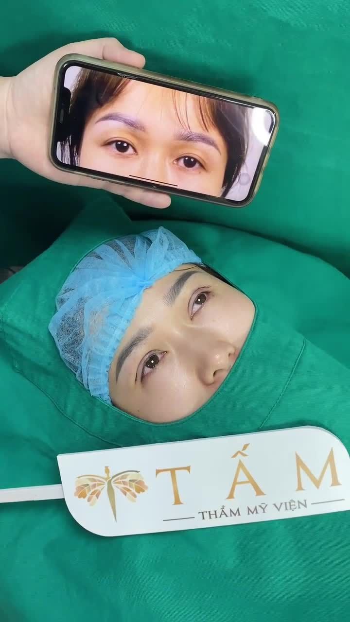 Combo Cắt mí + cấy mỡ mắt cải thiện mọi nhược điểm đôi mắt. Mọi người cùng so sánh trước và ngay sau làm nhé!