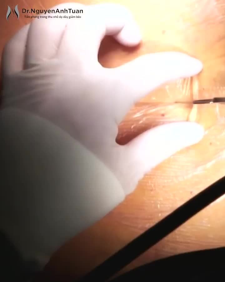 Phẫu thuật nội soi thu nhỏ dạ dày là giải pháp cuối cùng giúp cho bệnh nhân béo phì có thể giảm cân an toàn, hiệu quả.