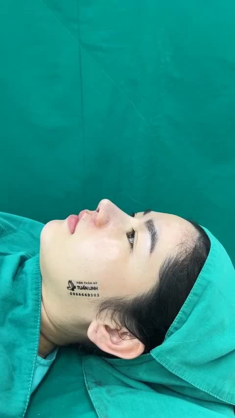 Phương pháp nâng mũi cấu trúc sụn tai+Surgiform.