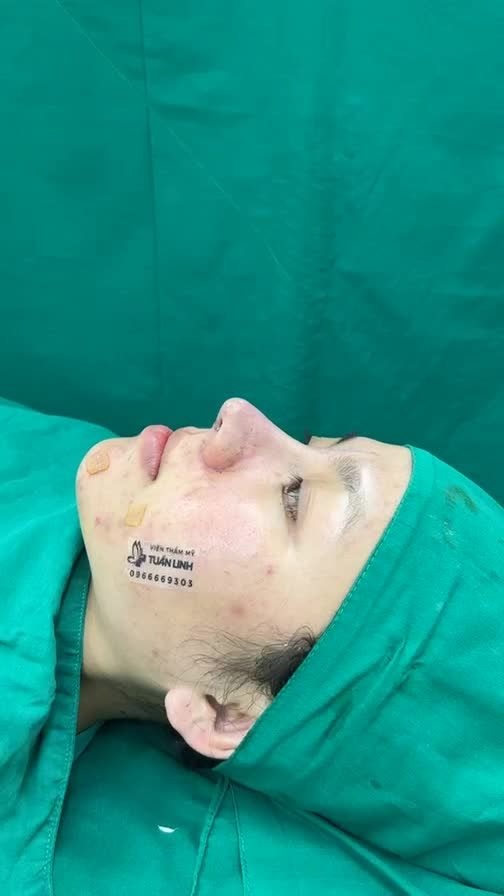 NÂNG MŨI CẤU TRÚC SUNRGIFORM- GIẢI PHÁP HOÀN HẢO CHO CHIẾC MŨI CAO XINH