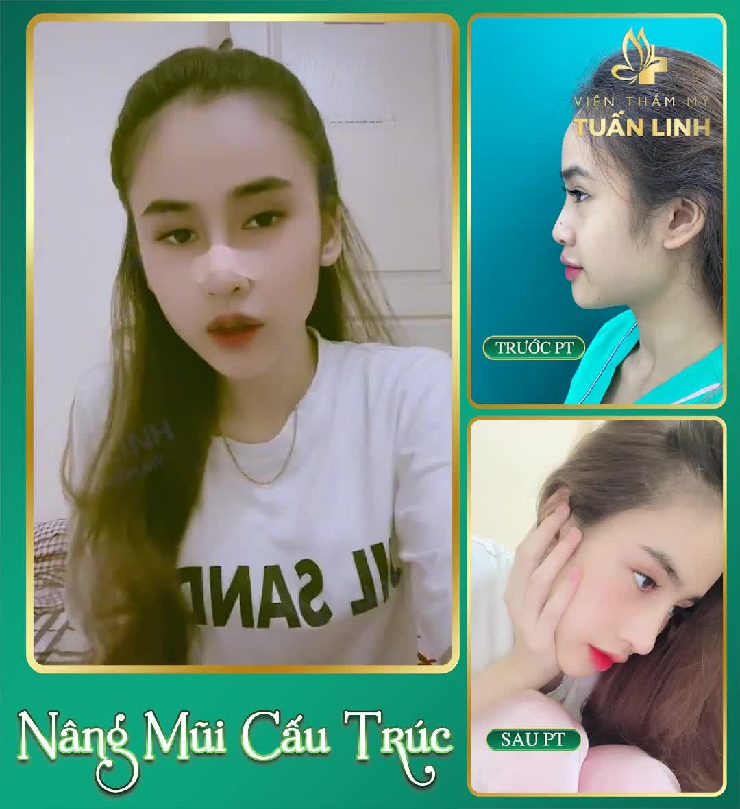 90 phút thực hiện, không đau, không sưng, nhanh lành.