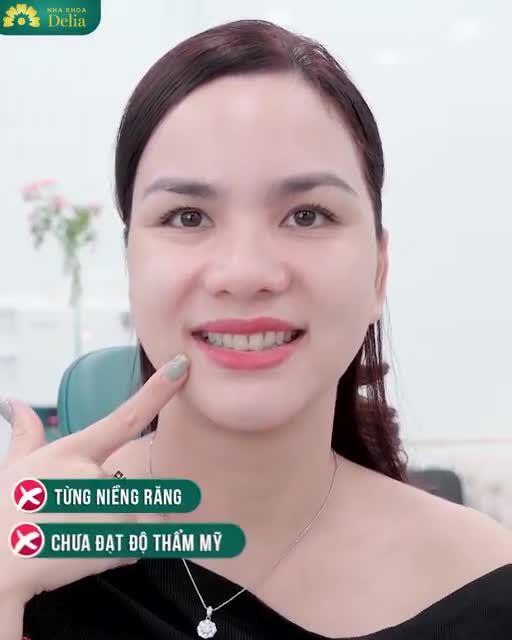 20 răng sứ Emax - Cười đẹp tự nhiên, thu hút mọi ánh nhìn