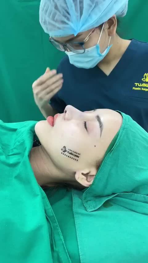Ca mũi siêu cấu trúc sửa lại bọc Megaderm cho bạn gái đến từ Kiên Giang