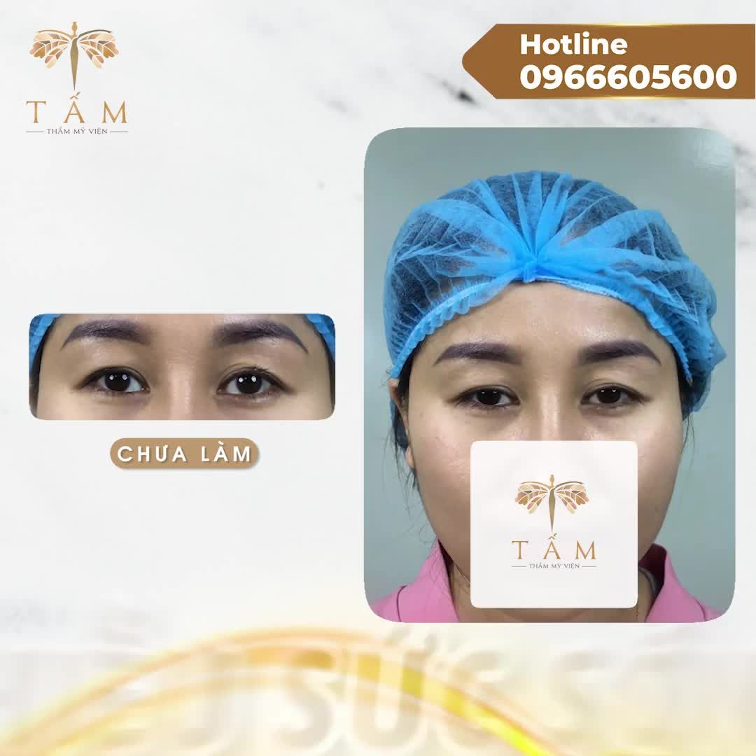 Mí sụp, dư nhiều khiến gương mặt thiếu sức sống, vô hồn. Chỉ mất 45 phút tại Tấm đã biến thành người hoàn toàn khác biệt