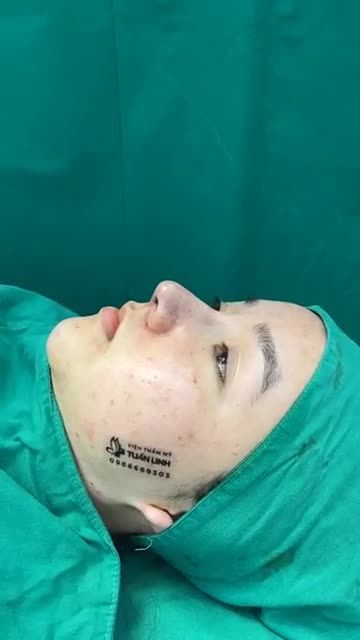 Case nâng mũi cấu trúc sụn sinh học Mỹ, bọc megaderm toàn sóng