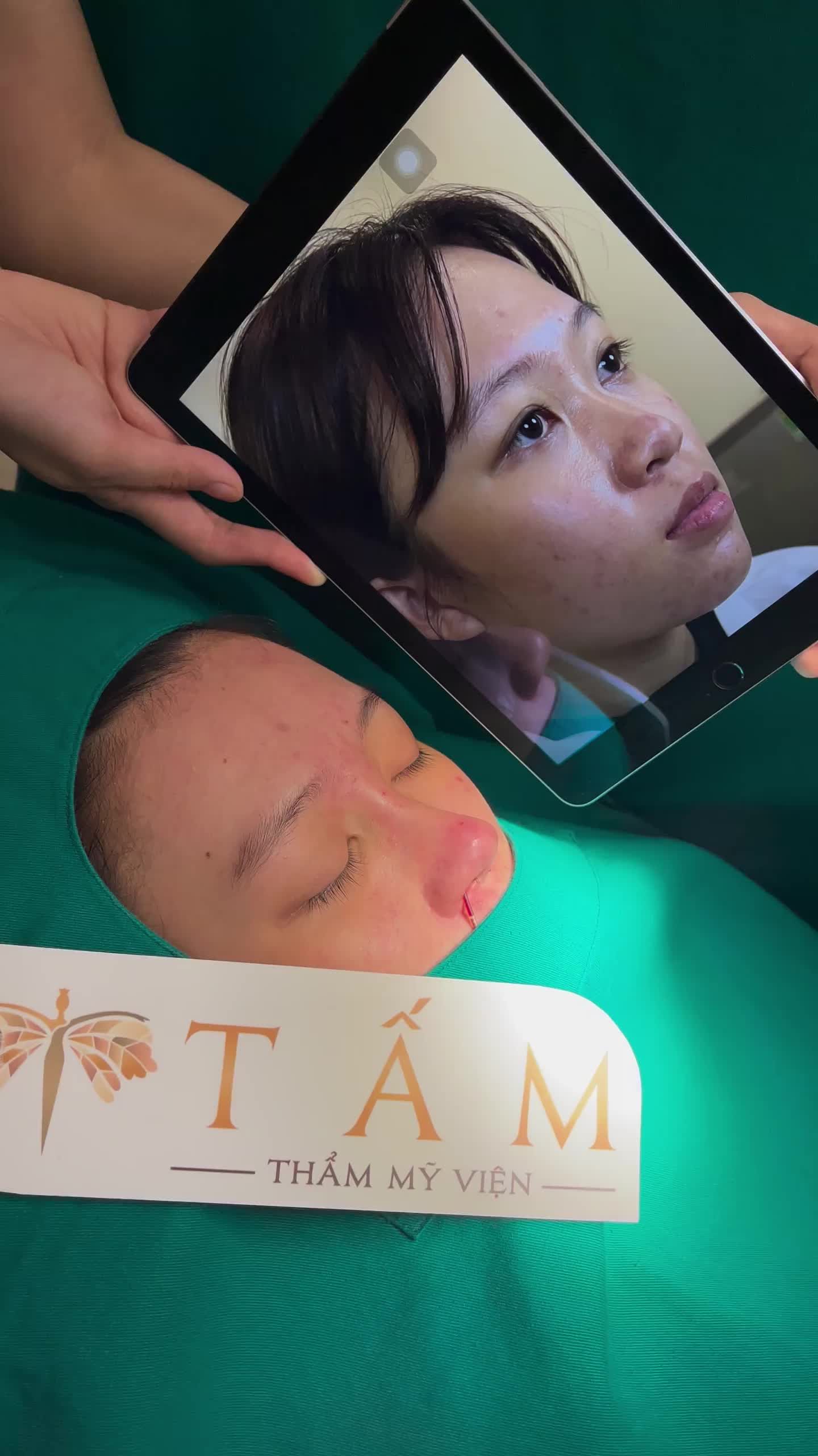 Chi tiết sự khác biệt ngay sau làm của chị khách hàng thực hiện Nâng mũi Surgiform + bọc sụn tai