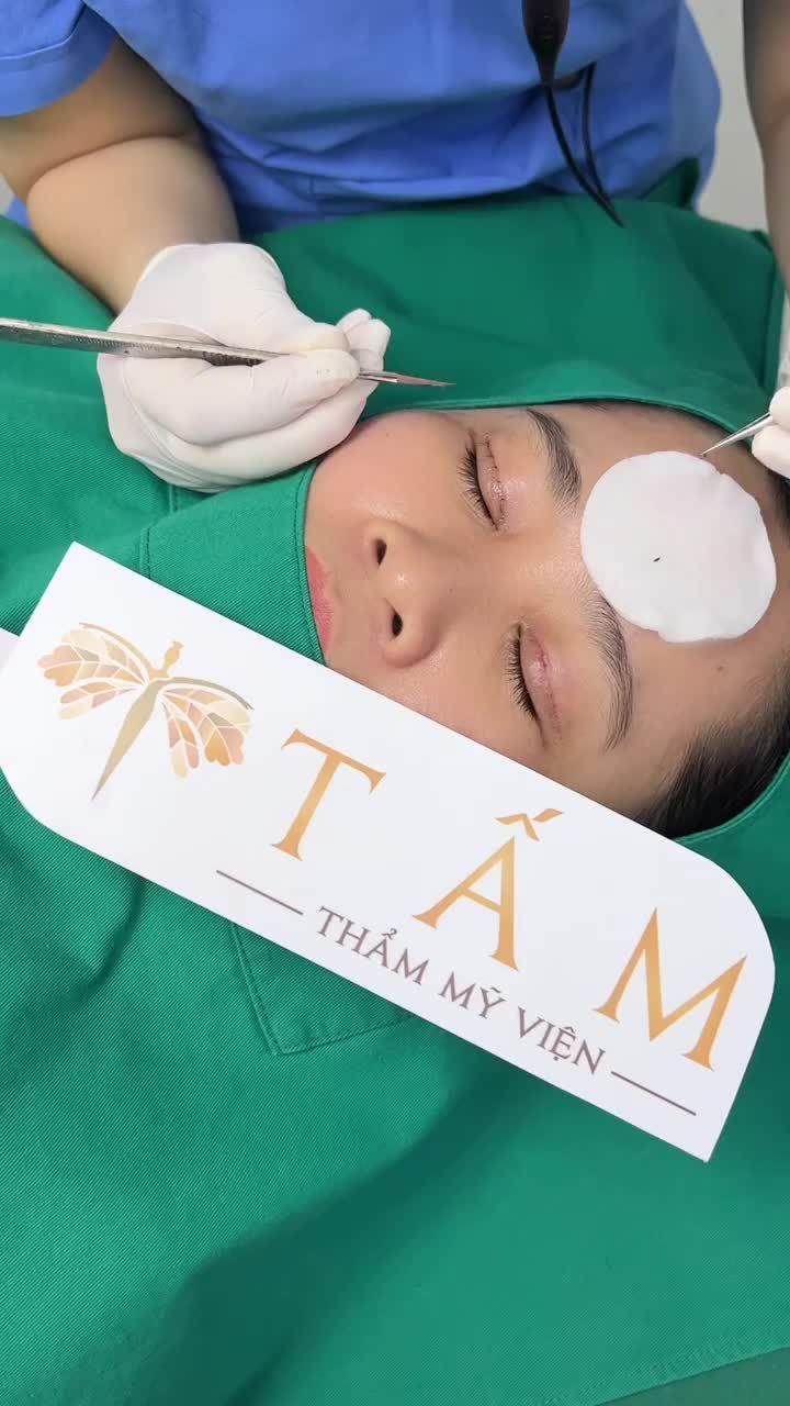 Khách hàng quay lại sau 6 ngày Cắt mí Line Mini tại TMV Tấm.