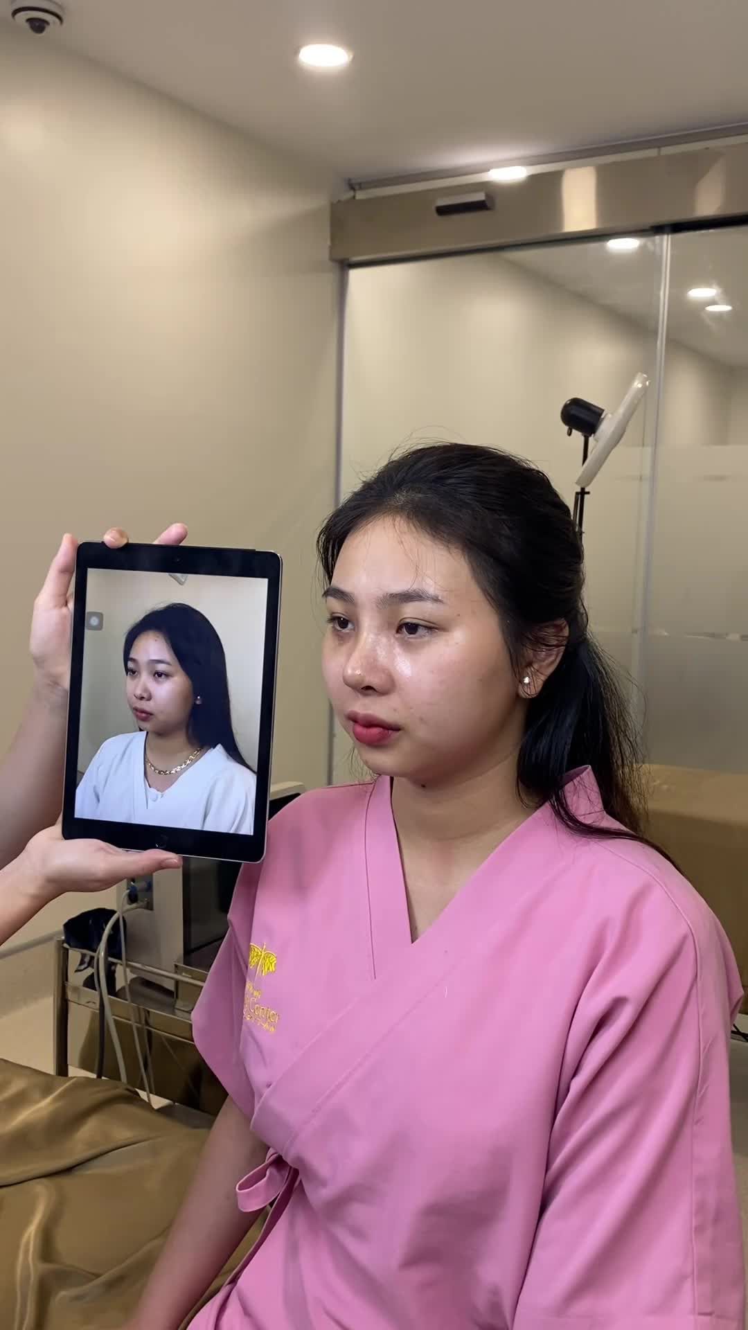 Khách hàng qua phòng khám cắt chỉ mũi và so sánh khác biệt trước - sau nâng