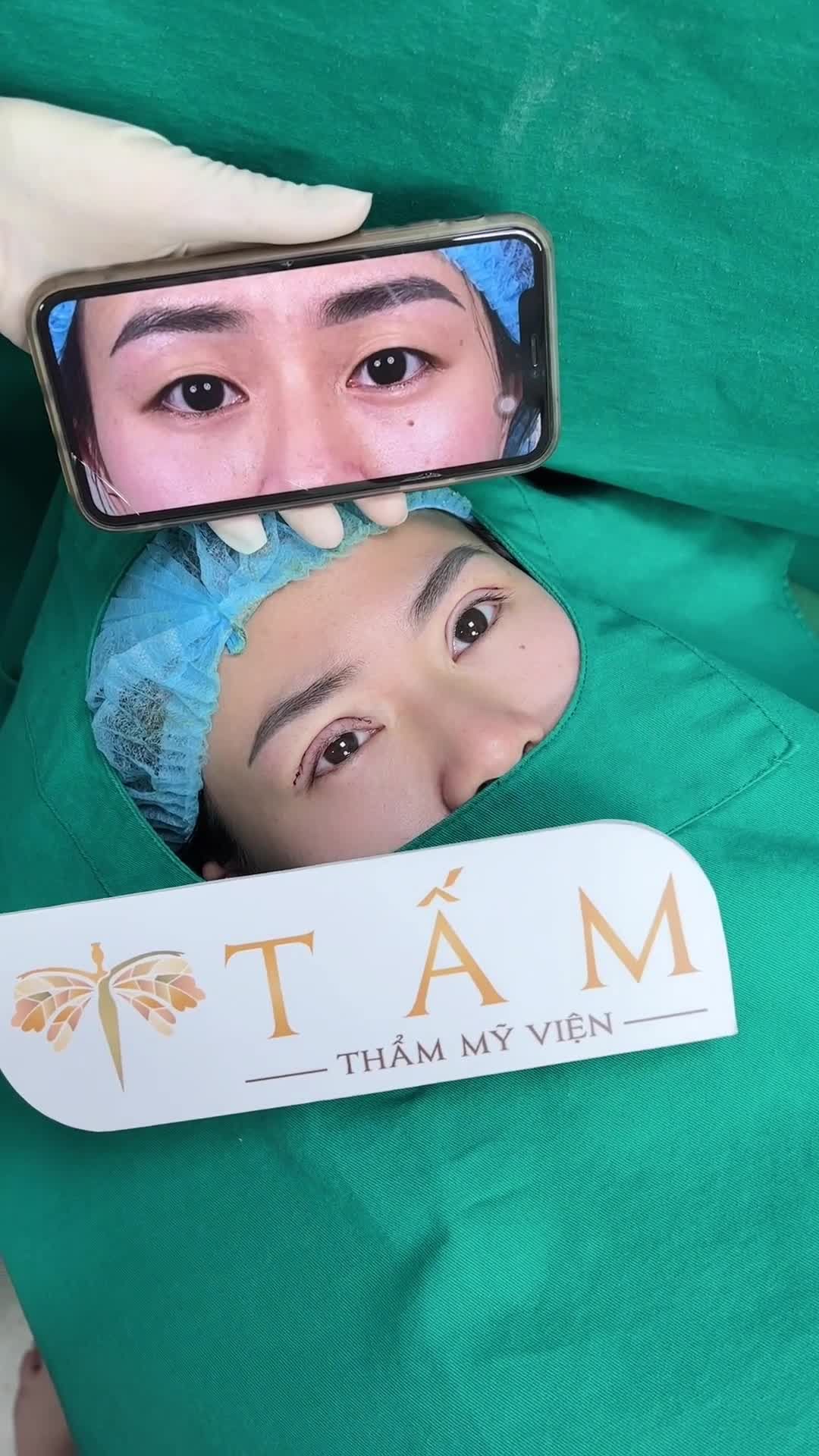 Thành quả của bác sĩ sau 45 phút thực hiện Cắt mí Line Mini. Mọi người cùng theo dõi sự khác biệt giữa trước và sau khi làm nhé!