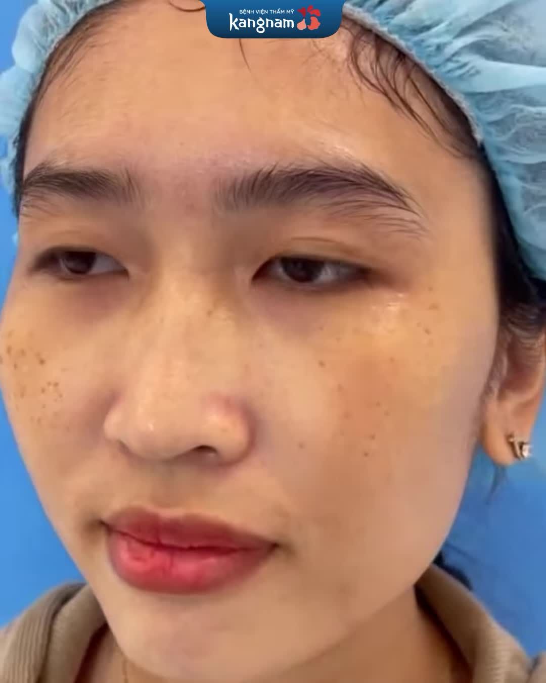Trị tàn nhang hiệu quả và an toàn với Laser Picosure