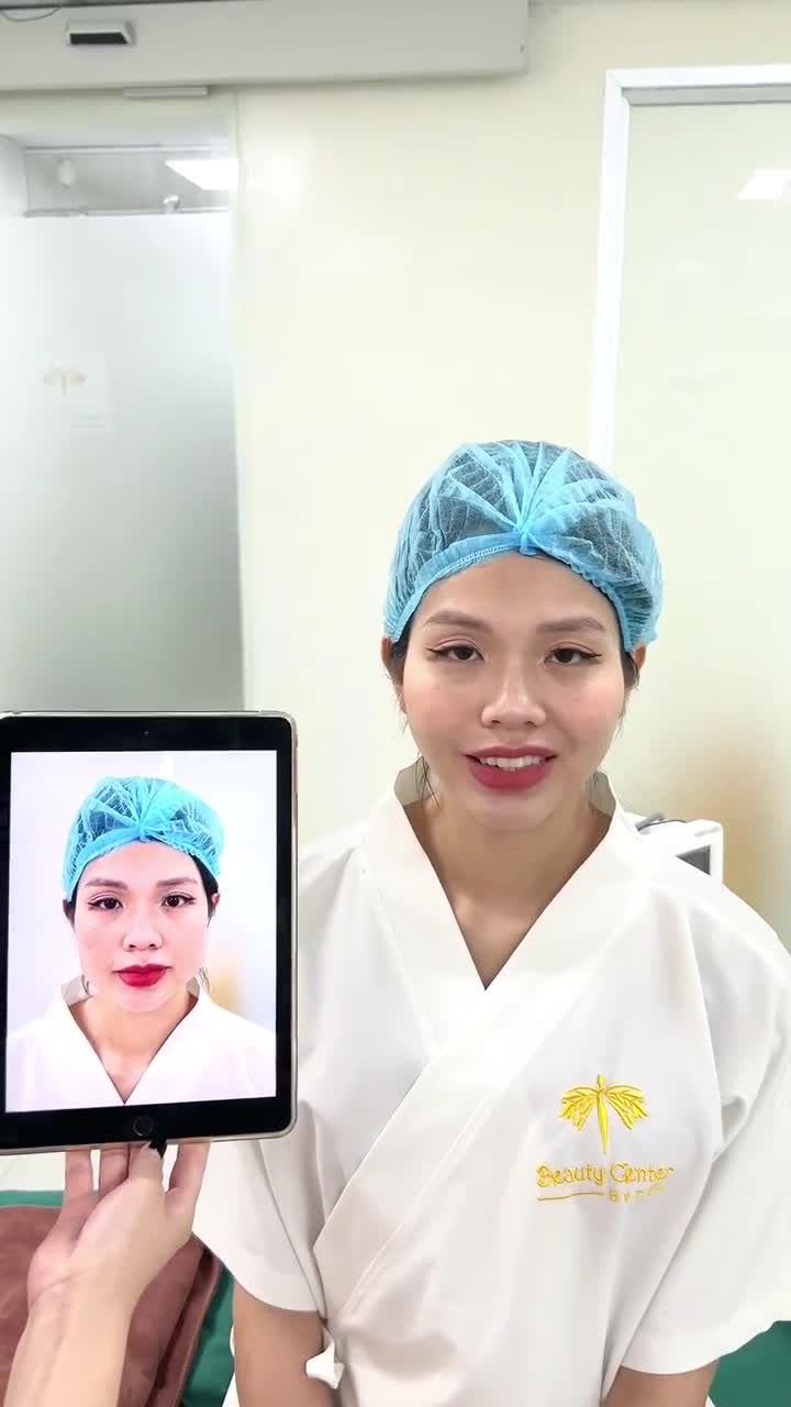Tiếp ca Vline thon gọn hàm sau 2 tháng quay lại tái khám
