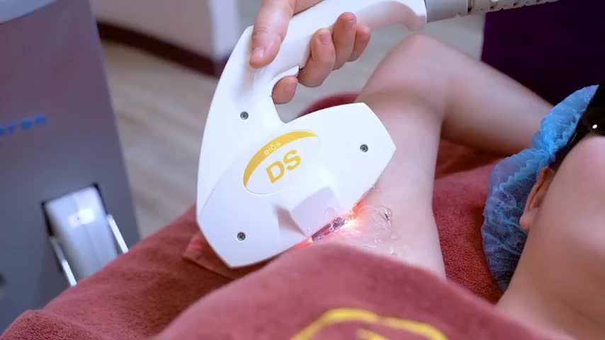 Triệt lông nách hiệu quả, duy trì dài lâu, không đau, không tổn thương da