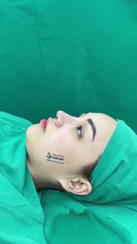 Chiêm ngưỡng kết quả Combo nâng mũi Siêu cấu trúc sửa lại Surgiform, bọc Megaderm + Nhấn mí cho vị khách đến từ Singapore
