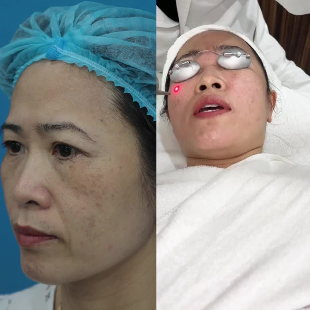 Những chia sẻ chân thật nhất của KH ngay trong khi điều trị Nám, tàn nhang bằng Laser Picosure