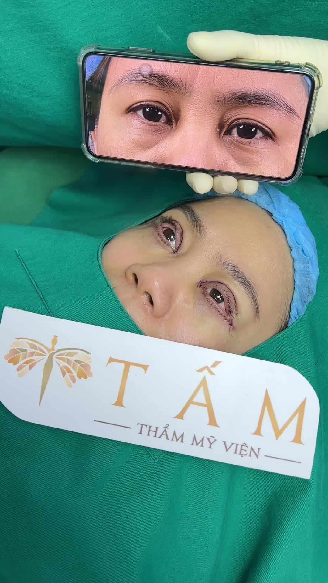 Kết thúc 45 phút thực hiện combo Cắt mí trên + mí dưới và mở góc trong tại Tấm.