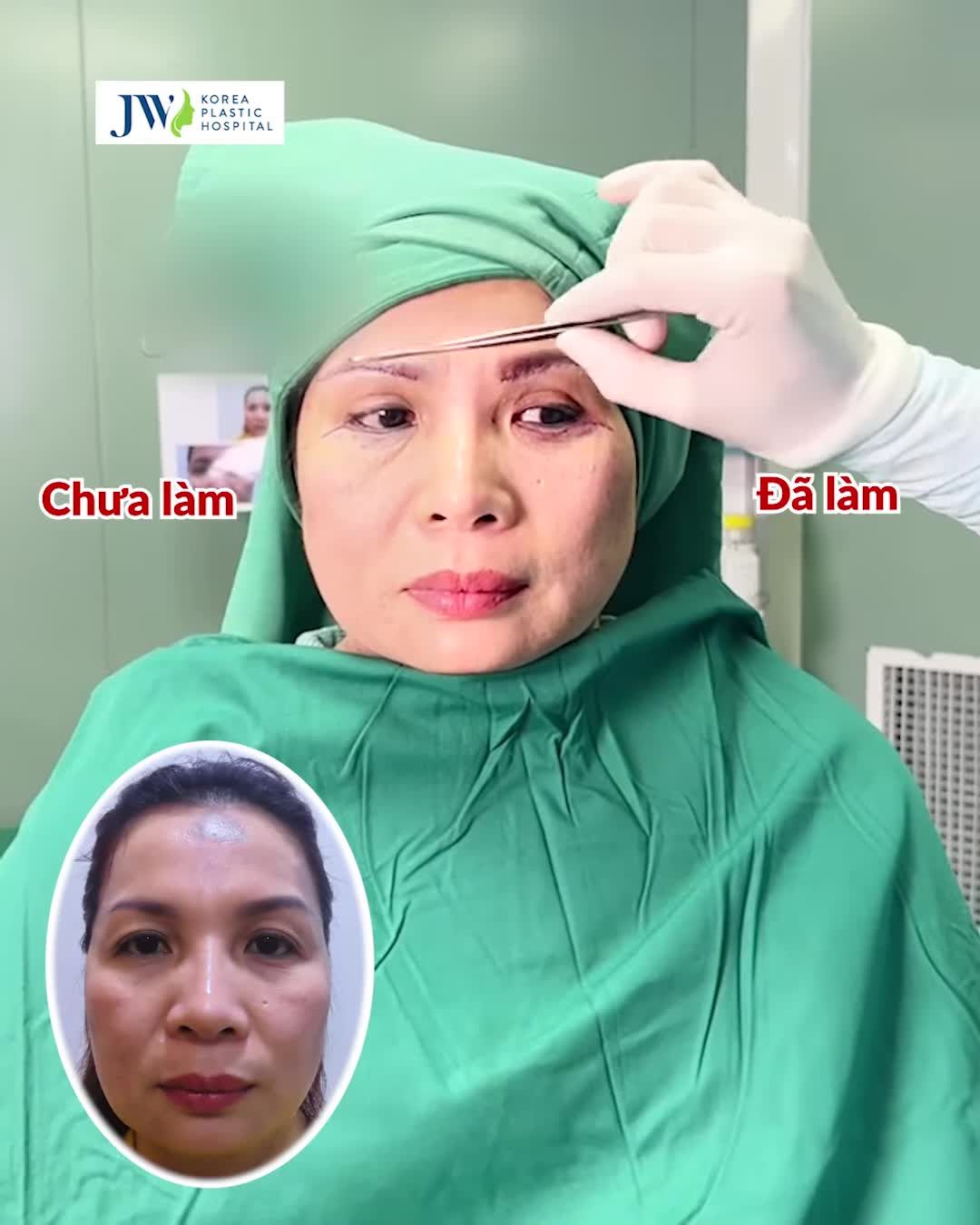 Thách ai không GIẬT MÌNH với vẻ đẹp TRẺ KHÔNG TUỔI sau Cải lão gương mặt 3M cho quý cô Việt kiều Mỹ