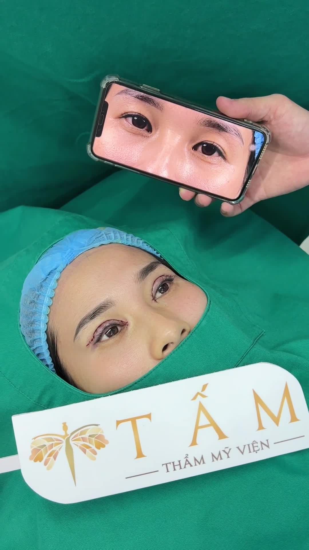 Combo Cắt mí + Mở góc trong + Cấy mỡ tại Tấm. Loại bỏ được mọi nhược điểm, mọi người cùng theo dõi nhé!
