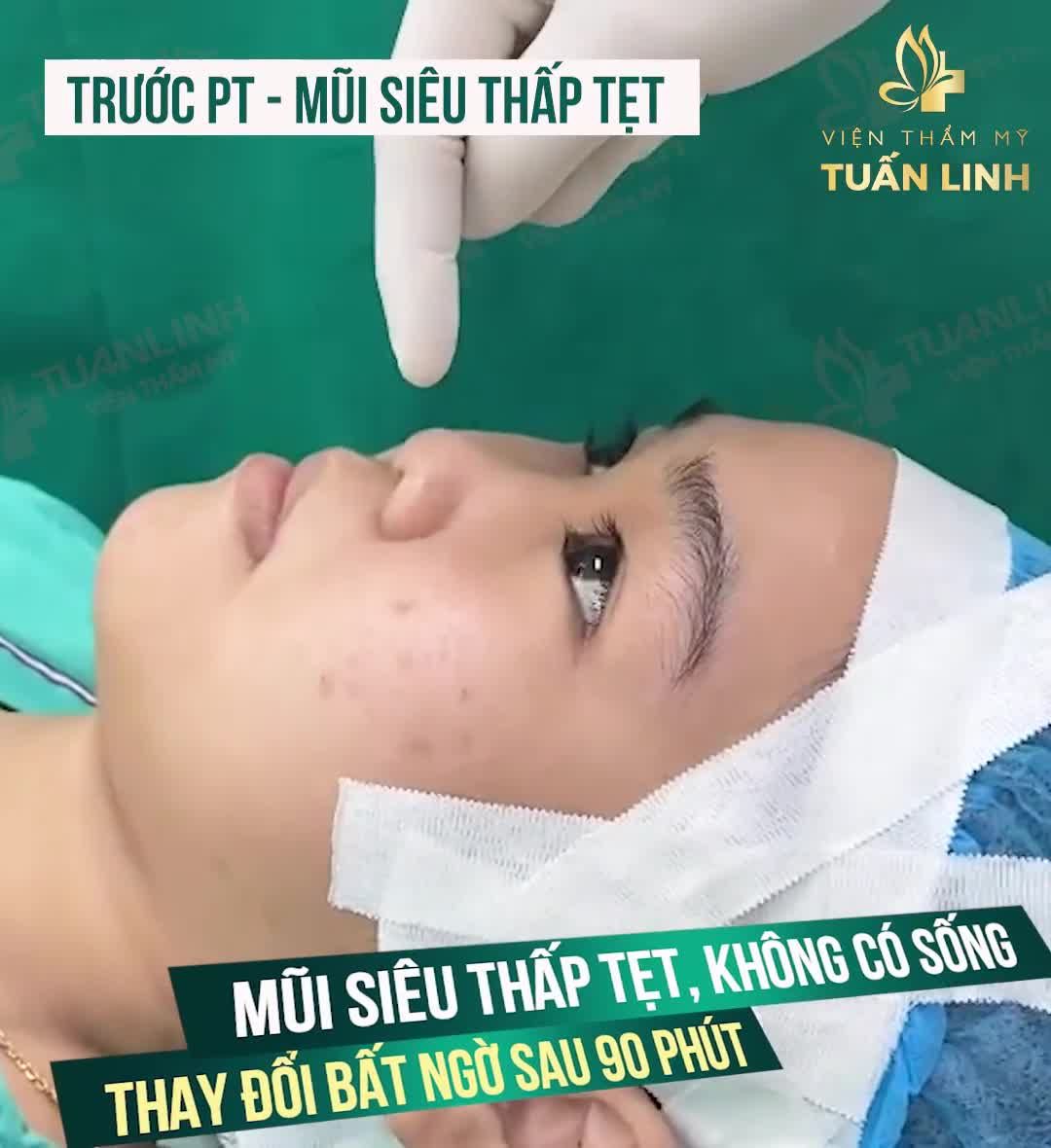 Biến hình dáng  mũi sau 90 phút