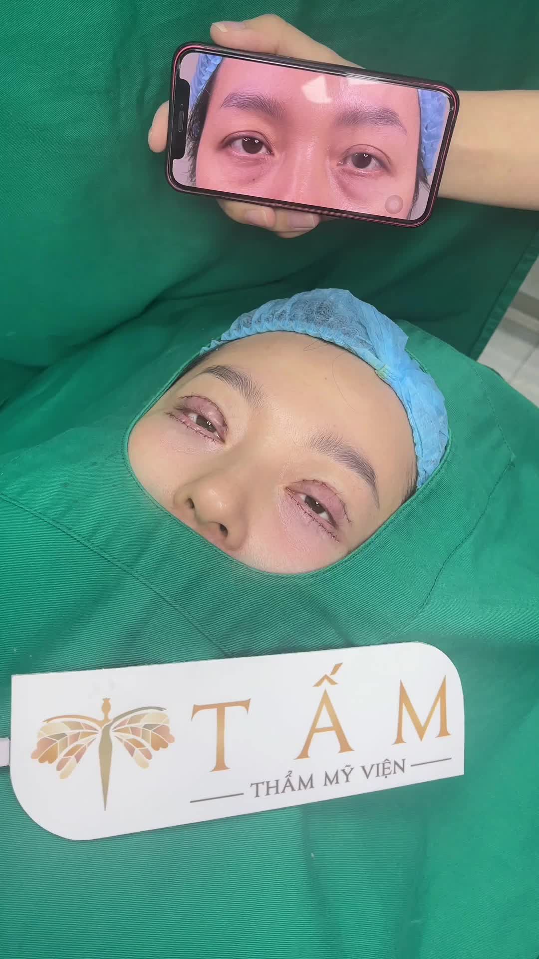 Kết quả của chị khách sau khi Cắt mí trên + Cắt mí dưới tại TMV Tấm. Mọi người cùng theo dõi sự khác biệt nhé!