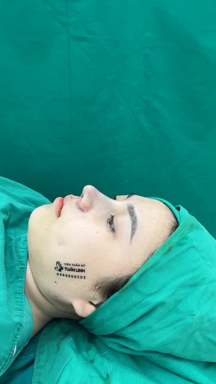 Case mũi cấu trúc sụn sinh học Mỹ + Cuộn cánh mũi vừa hoàn thành