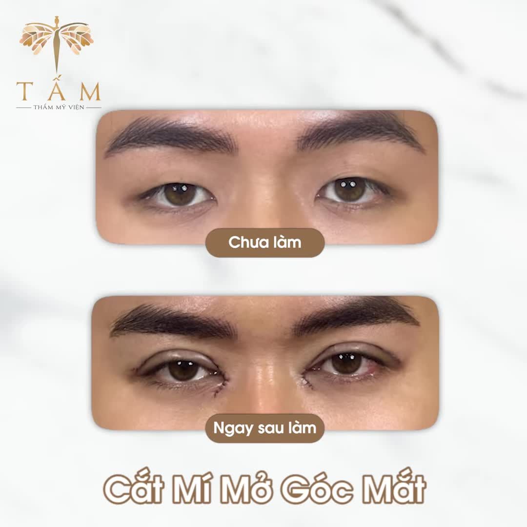 Cắt mí + Mở góc mắt - Kiến tạo đôi mắt hoàn hảo