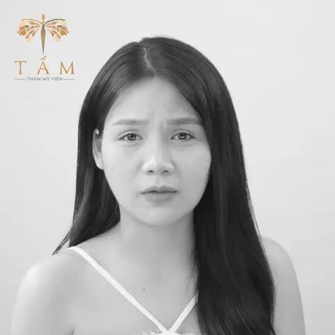 Cắt mí + mở góc mắt sau 3 tháng nhé!