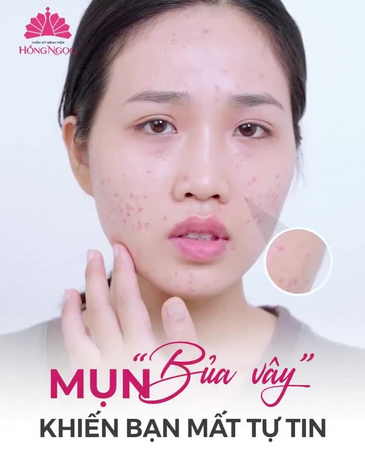 ĐỊA ĐIỂM TRỊ MỤN ''CỰC CHẤT LƯỢNG'' DÀNH CHO CÁC ANHCHỊEM ĐÂY Ạ