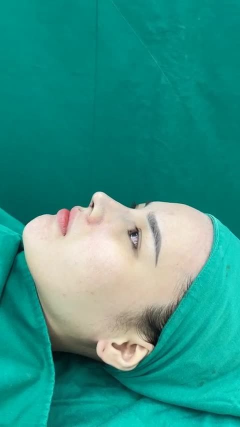 Hoàn thành case nâng mũi cấu trúc cho bạn gái đến từ Huế.