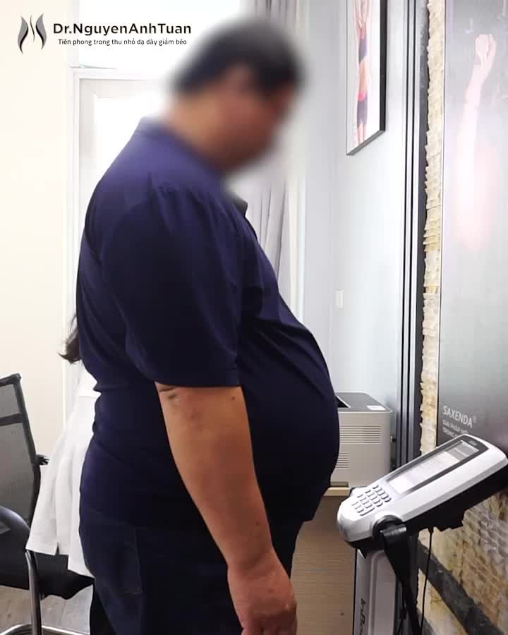 Khởi động đầu tuần với ca phẫu thuật thu nhỏ dạ dày giảm béo cho bệnh nhân có chỉ số BMI khủng.