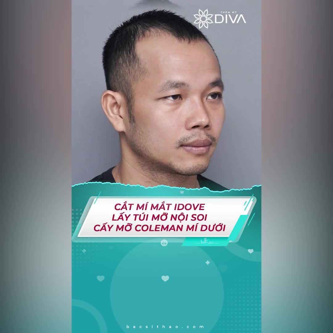MÍ SỤP, MẮT TO MẮT NHỎ LÀM SAO CẢI THIỆN